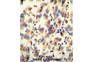 UGT3A2 antibody (C-term) immunohistochemistry analysis in formalin fixed and paraffin embedded human testis carcinoma followed by peroxidase conjugation of the secondary antibody and DAB staining. (UGT3A2 Antikörper  (C-Term))