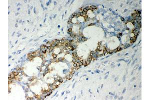 Anti- Caspase-7 Picoband antibody,IHC(P) IHC(P): Human Mammary Cancer Tissue (Caspase 7 Antikörper  (AA 117-198))