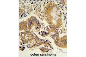 Formalin-fixed and paraffin-embedded human colon carcinoma reacted with CLNS1A Antibody (Center), which was peroxidase-conjugated to the secondary antibody, followed by DAB staining. (CLNS1A Antikörper  (AA 148-176))