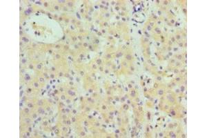 Immunohistochemistry of paraffin-embedded human liver cancer using ABIN7148380 at dilution of 1:100 (Complement Factor B Antikörper  (AA 26-751))