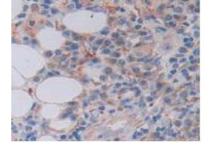 IHC-P analysis of Human Skin Cancer Tissue, with DAB staining. (FKBP7 Antikörper  (AA 24-217))