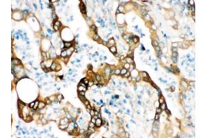 IHC analysis of FASN using anti-FASN antibody (ABIN3044520).