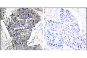 Immunohistochemistry analysis of paraffin-embedded human breast carcinoma tissue, using MUNC-18a (Ab-313) Antibody. (STXBP1 Antikörper  (AA 279-328))