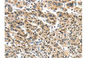 The image on the left is immunohistochemistry of paraffin-embedded Human liver cancer tissue using (TKTL1 Antibody) at dilution 1/40, on the right is treated with fusion protein. (TKTL1 Antikörper)