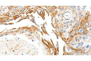 Immunohistochemistry of paraffin-embedded Human esophagus cancer using PLAT Polyclonal Antibody at dilution of 1:50 (PLAT Antikörper)