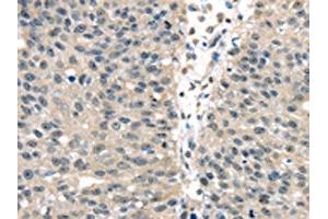 The image on the left is immunohistochemistry of paraffin-embedded Human breast cancer tissue using ABIN7128063(UCHL3 Antibody) at dilution 1/25, on the right is treated with fusion protein. (UCHL3 Antikörper)