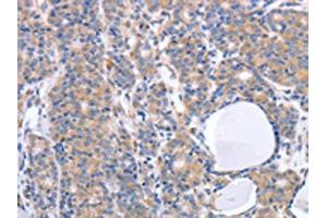 The image on the left is immunohistochemistry of paraffin-embedded Human thyroid cancer tissue using ABIN7190789(GFRA4 Antibody) at dilution 1/40, on the right is treated with synthetic peptide. (GFRA4 Antikörper)