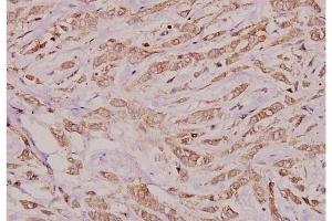 Immunohistochemistry analysis of Connexin-32 antibody in paraffin-embedded human breast carcinoma tissue at 1/100 dilution. (GJB1 Antikörper)