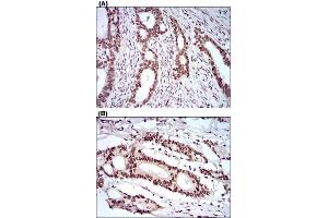 Immunohistochemical staining of cervical cancer tissues (A) and colon cancer tissues (B) with KHDRBS2 monoclonal antibody, clone 7G8C10  at 1:200-1:1000 dilution. (KHDRBS2 Antikörper  (AA 160-349))