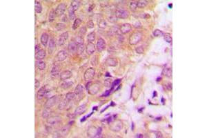 Immunohistochemical analysis of Caspase 6 staining in human prostate cancer formalin fixed paraffin embedded tissue section. (Caspase 6 Antikörper  (C-Term))