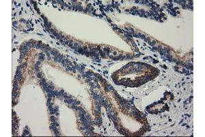 Immunohistochemical staining of paraffin-embedded Carcinoma of Human prostate tissue using anti-RASD2 mouse monoclonal antibody. (RASD2 Antikörper)