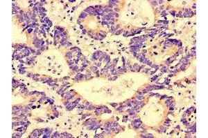 Immunohistochemistry of paraffin-embedded human colon cancer using ABIN7143463 at dilution of 1:100 (GGA1 Antikörper  (AA 1-89))