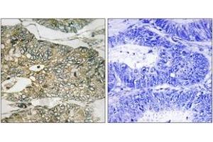 Immunohistochemistry analysis of paraffin-embedded human colon carcinoma, using GRB2 (Phospho-Ser159) Antibody.