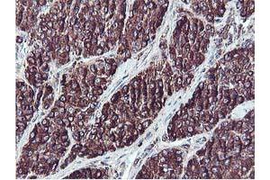 Immunohistochemical staining of paraffin-embedded Carcinoma of Human liver tissue using anti-ILVBL mouse monoclonal antibody. (ILVBL Antikörper)