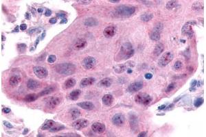 Anti-ESRRA antibody  ABIN1048580 IHC staining of human breast carcinoma. (ESRRA Antikörper  (Internal Region))