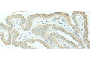 Immunohistochemistry of paraffin-embedded Human thyroid cancer tissue using EVI2B Polyclonal Antibody at dilution of 1:40(x200) (EVI2B Antikörper)