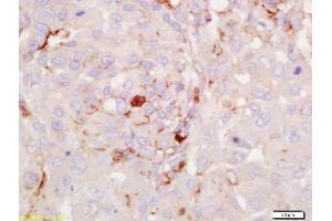 Formalin-fixed and paraffin embedded human lung carcinoma labeled with Anti-RGS2 Polyclonal Antibody, Unconjugated (ABIN669291) at 1:200 followed by conjugation to the secondary antibody and DAB staining. (RGS2 Antikörper  (AA 116-211))