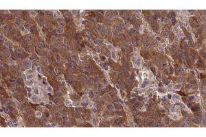 ABIN6277377 at 1/100 staining Human liver cancer tissue by IHC-P. (Metabotropic Glutamate Receptor 1 Antikörper  (Internal Region))