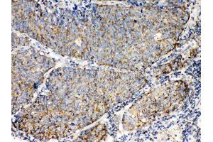 TECTA was detected in paraffin-embedded sections of human lung cancer tissues using rabbit anti- TECTA Antigen Affinity purified polyclonal antibody (Catalog # ) at 1 µg/mL.
