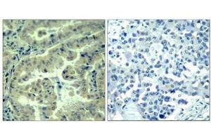 Immunohistochemical analysis of paraffin-embedded human lung carcinoma tissue using eIF4G(Phospho-Ser1232) Antibody(left) or the same antibody preincubated with blocking peptide(right). (EIF4G1 Antikörper  (pSer1232))