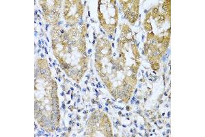 Immunohistochemistry of paraffin-embedded human gastric cancer using ASIP antibody at dilution of 1:100 (40x lens). (ASIP Antikörper)