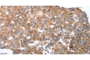 Immunohistochemistry of paraffin-embedded Human breast cancer using NQO2 Polyclonal Antibody at dilution of 1:50 (NQO2 Antikörper)