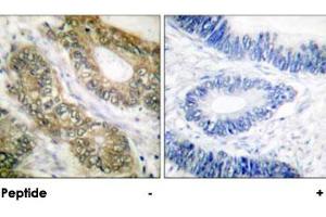 Immunohistochemical analysis of paraffin-embedded human colon carcinoma tissue using ESPL1 polyclonal antibody .