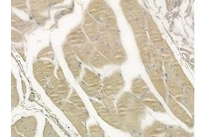 ABIN6258598 and ABIN6273579 at 1/100 staining human tongue carcinoma by IHC-P.