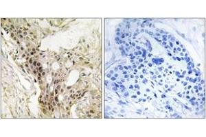 Immunohistochemistry analysis of paraffin-embedded human breast carcinoma tissue, using MED21 Antibody.