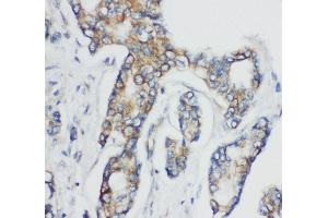 Anti-CD1d antibody, IHC(P) IHC(P): Human Mammary Cancer Tissue (CD1d Antikörper  (N-Term))