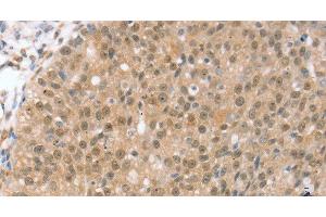 Immunohistochemistry of paraffin-embedded Human breast cancer using TRIM35 Polyclonal Antibody at dilution of 1:35 (TRIM35 Antikörper)