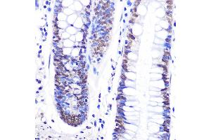 Immunohistochemistry of paraffin-embedded human colon using Snail Rabbit pAb (ABIN6134928, ABIN6148176, ABIN6148179 and ABIN6215911) at dilution of 1:100 (40x lens). (SNAIL Antikörper  (C-Term))