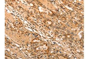 The image on the left is immunohistochemistry of paraffin-embedded Human gastic cancer tissue using ABIN7189699(ADRA1B Antibody) at dilution 1/20, on the right is treated with synthetic peptide. (ADRA1B Antikörper)