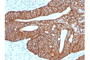 Formalin-fixed, paraffin-embedded human Colon Carcinoma stained with Cytokeratin 18Rabbit Recombinant Monoclonal Antibody (KRT18/2819R). (Rekombinanter Cytokeratin 18 Antikörper)