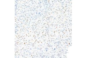 Immunohistochemistry (IHC) image for anti-Zinc Finger E-Box Binding Homeobox 1 (ZEB1) (AA 750-800) antibody (ABIN7455173) (Rekombinanter ZEB1 Antikörper  (AA 750-800))