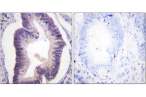 Immunohistochemistry analysis of paraffin-embedded human colon carcinoma tissue, using PFKFB2 (Ab-483) Antibody. (PFKFB2 Antikörper  (AA 451-500))