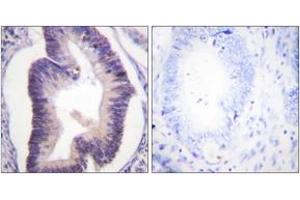 Immunohistochemistry analysis of paraffin-embedded human colon carcinoma tissue, using PFKFB2 (Ab-483) Antibody.