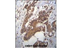 PCYT1A Antibody (N-term) (ABIN656103 and ABIN2845445) immunohistochemistry analysis in formalin fixed and paraffin embedded human colon carcinoma followed by peroxidase conjugation of the secondary antibody and DAB staining.