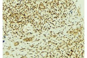 ABIN6269322 at 1/100 staining Human breast cancer tissue by IHC-P. (FAK Antikörper  (Internal Region))