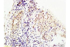 Formalin-fixed and human breast carcinoma tissue labeled with Anti-MMS19 Polyclonal Antibody, Unconjugated at 1:200 followed by conjugation to the secondary antibody and DAB staining (MMS19 Antikörper  (AA 851-950))