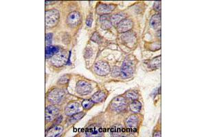 Formalin-fixed and paraffin-embedded human breast carcinoma tissue reacted with CDH13 polyclonal antibody  , which was peroxidase-conjugated to the secondary antibody, followed by DAB staining.
