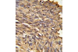 Immunohistochemistry in formalin-fixed and paraffin-embedded human lung carcinoma reacted with Vigilin / HDLBP Antibody (Center) followed which was peroxidase-conjugated to the secondary antibody, followed by DAB staining. (HDLBP Antikörper  (Middle Region))