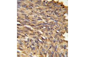 Immunohistochemistry in formalin-fixed and paraffin-embedded human lung carcinoma reacted with Vigilin / HDLBP Antibody (Center) followed which was peroxidase-conjugated to the secondary antibody, followed by DAB staining.