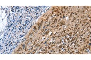 Immunohistochemistry of paraffin-embedded Human cervical cancer using MCM6 Polyclonal Antibody at dilution of 1:45