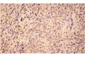 Immunohistochemistry analysis of human breast cancer tissue with HO-2 pAb. (HMOX2 Antikörper  (N-Term))