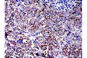 Immunohistochemical analysis of paraffin-embedded human cervical cancer tissues using AIF mouse mAb with DAB staining.