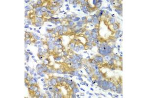 Immunohistochemistry of paraffin-embedded human gastric cancer using TFAM antibody at dilution of 1:100 (x40 lens). (TFAM Antikörper)
