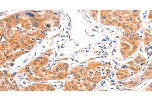 Immunohistochemistry of paraffin-embedded Human lung cancer using AMPD1 Polyclonal Antibody at dilution of 1:80 (AMPD1 Antikörper)
