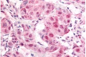 Human Breast Carcinoma (formalin-fixed, paraffin-embedded) stained with E2F1 antibody ABIN214450 at 10 ug/ml followed by biotinylated goat anti-rabbit IgG secondary antibody ABIN481713, alkaline phosphatase-streptavidin and chromogen. (E2F1 Antikörper  (pSer364))