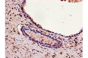 Immunohistochemistry of paraffin-embedded human prostate cancer using ABIN7154138 at dilution of 1:100 (GAPDH Antikörper  (AA 3-335))